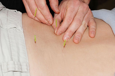 Medical acupuncture treatment