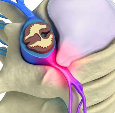 Herniated disc