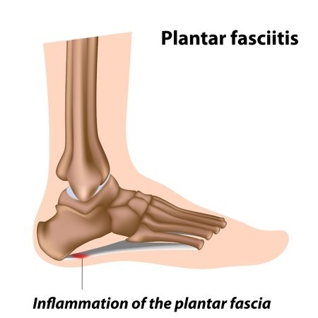 15 Common Foot Problems - Painful Condition Names, Causes, Treatments